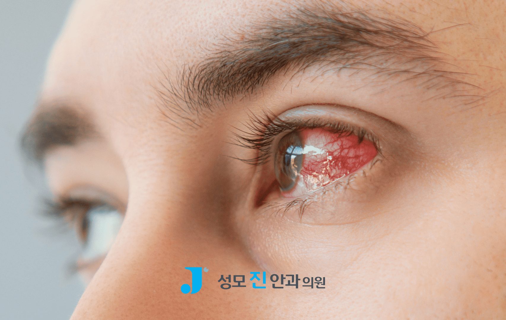 포도막염 증상과 원인 3가지, 방치하면 실명 위험까지!