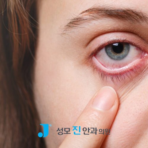 반복되는 각막 상처, 각막 미란 치료 방법 3가지로 관리