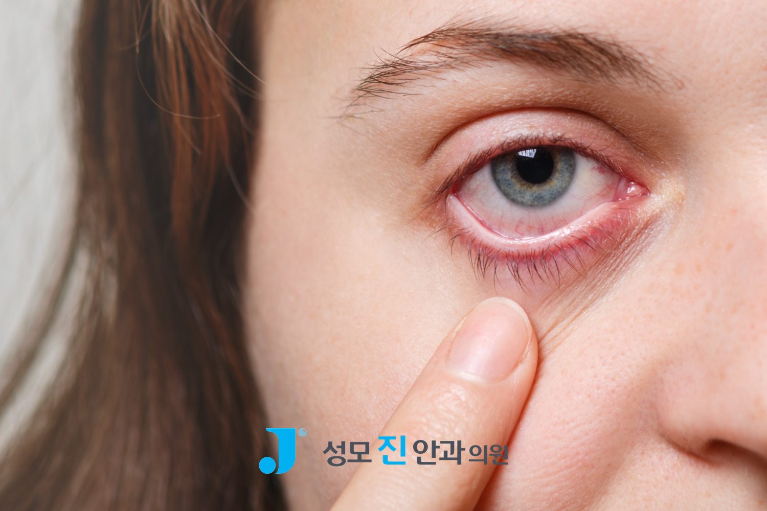 반복되는 각막 상처, 각막 미란 치료 방법 3가지로 관리