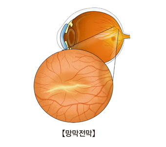  망막 전막, 황반주름, 암슬러격자, OCT 검사, 유리체 절제술