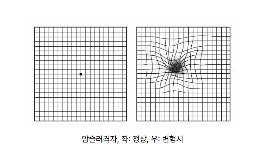 망막 전막, 황반주름, 암슬러격자, OCT 검사, 유리체 절제술
