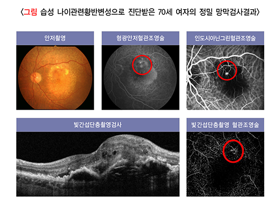 망막 전막, 황반주름, 암슬러격자, OCT 검사, 유리체 절제술