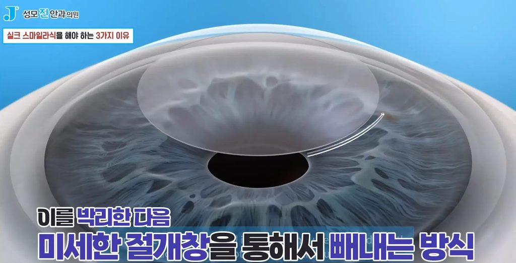 스마일 라식 안 되는 눈, 스마일 라식 난시, 초고도근시 라섹, 라식 스마일 라식 차이, 실크 스마일 라식