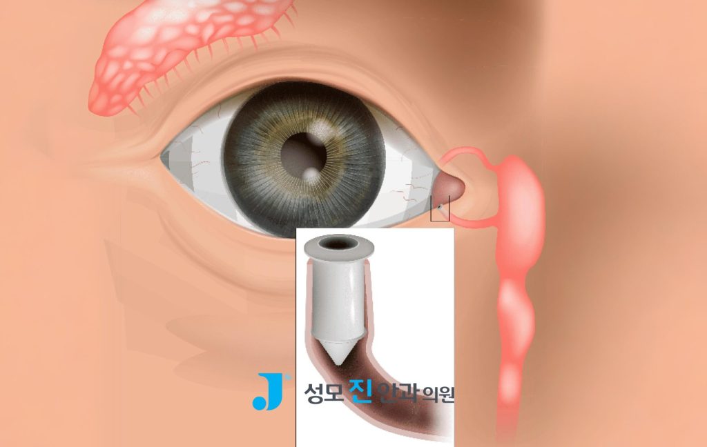 누점폐쇄술, 누점 플러그, 안구 건조증 치료, 안구 건조증 원인, 눈물점