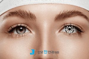 공막고정술, 백내장 수술 후, 백내장 수술 과정, 야마네, 인공수정체 탈구