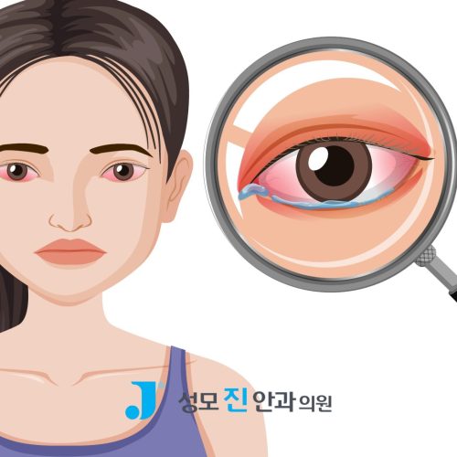 눈 충혈 상공막염일까, 결막염일까? 3가지 차이 알아보기