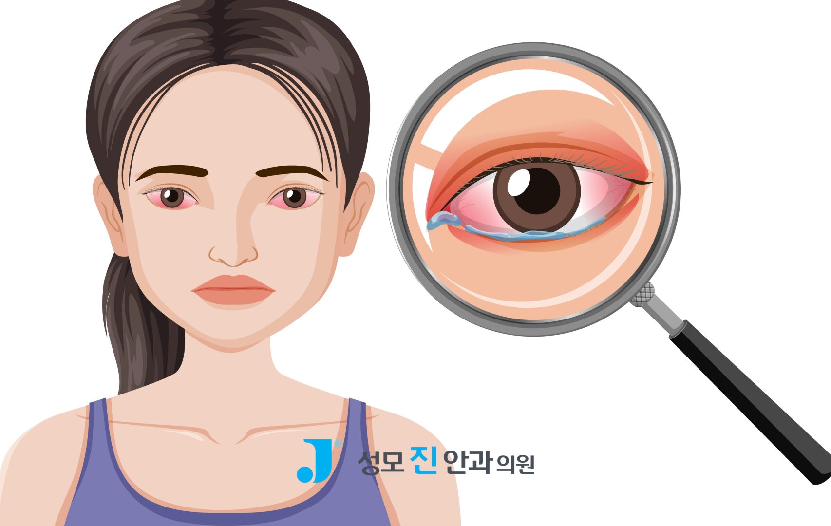 눈 충혈 상공막염일까, 결막염일까? 3가지 차이 알아보기
