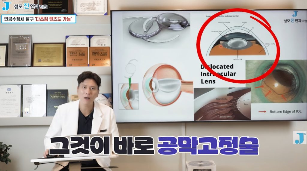  공막고정술, 백내장 수술 후, 백내장 수술 과정, 야마네, 인공수정체 탈구