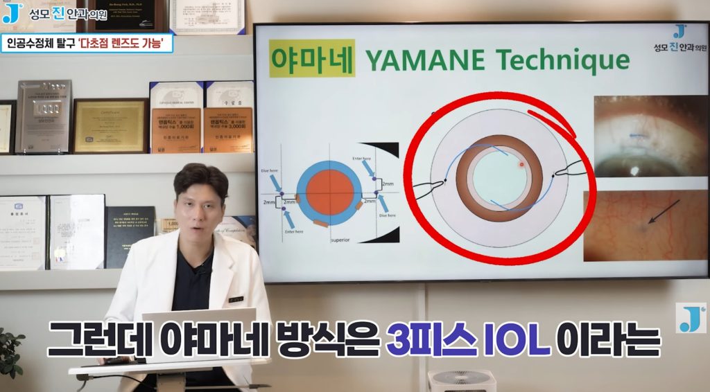  공막고정술, 백내장 수술 후, 백내장 수술 과정, 야마네, 인공수정체 탈구