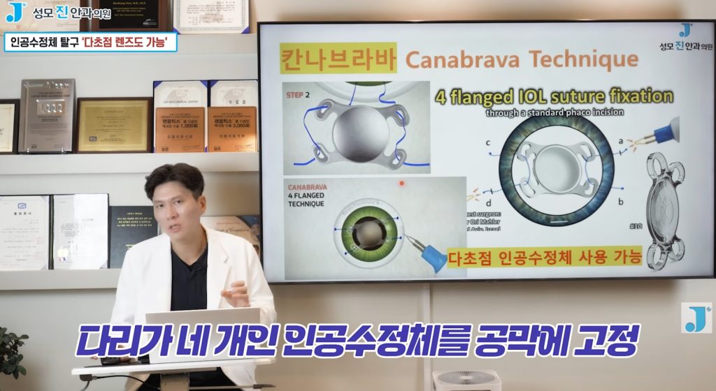  공막고정술, 백내장 수술 후, 백내장 수술 과정, 야마네, 인공수정체 탈구