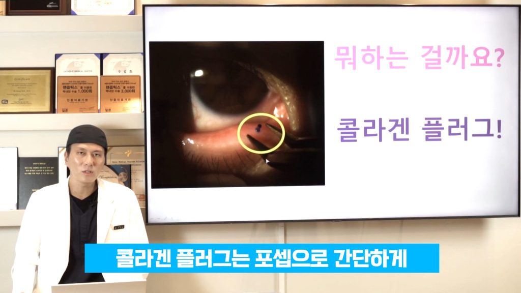 누점폐쇄술, 누점 플러그, 안구 건조증 치료, 안구 건조증 원인, 눈물점