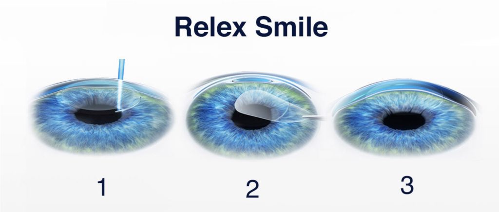 라식 종류, 실크 스마일 라식, 고도 근시 라식, 스마일 라식 라식 차이, 스마일 라식 시력 회복