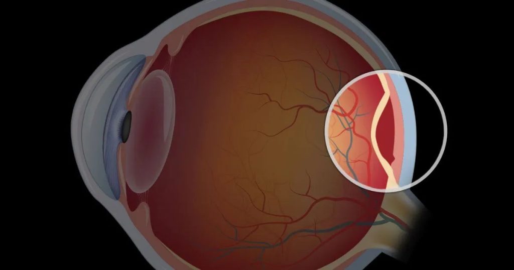 망막박리 골든 타임, 망막박리 치료, 망막박리 진행 속도, 망막박리 실명 확률, 망막박리 예방