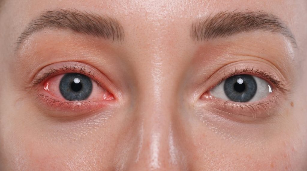 결막염 빨리 낫는 법, 결막염 증상, 결막염 전염, 결막염 걸리는 이유, 결막염 안약