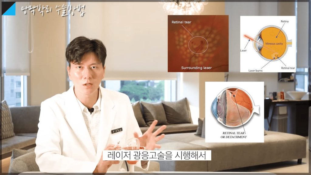 망막박리 골든 타임, 망막박리 치료, 망막박리 진행 속도, 망막박리 실명 확률, 망막박리 예방