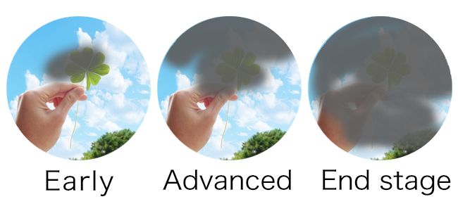  백내장 녹내장 차이, 백내장 증상, 백내장 치료, 녹내장 증세, 안압 낮추기