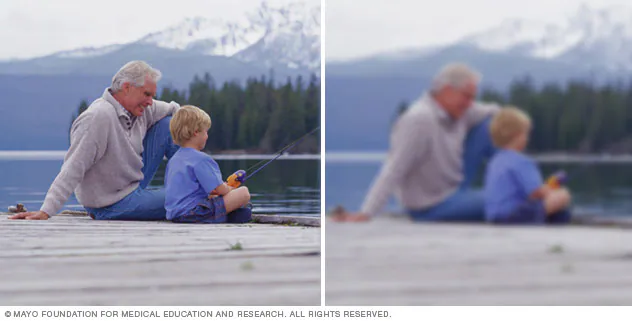  백내장 녹내장 차이, 백내장 증상, 백내장 치료, 녹내장 증세, 안압 낮추기