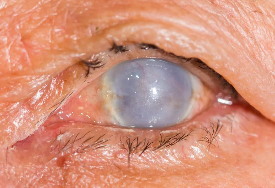 라섹 각막 혼탁 증상, 라섹 회복 기간, 라섹 후 시력 저하, 라섹 시력 회복, 초고도 근시 라섹