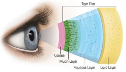 라섹 각막 혼탁 증상, 라섹 회복 기간, 라섹 후 시력 저하, 라섹 시력 회복, 초고도 근시 라섹