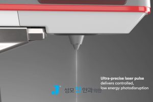 스마일 라식 기계, 스마일 라식 시력, 스마일 라식 빛 번짐, 라식 부작용 확률, 스마일 라식 원리