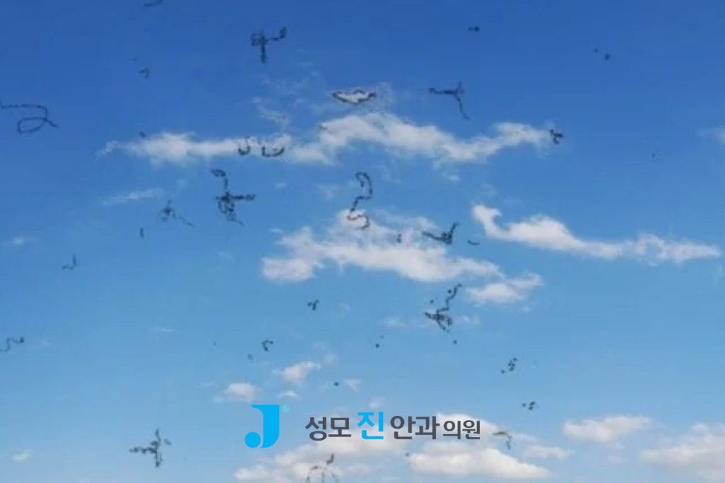 망막 주사, 눈에 이상한 잔상, 망막질환 종류, 망막 구조, 안구 내 주사