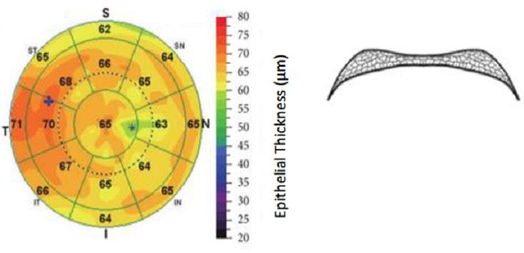 라섹 후 관리, 라섹 시력 회복, 라섹 보호 안경, 라섹 근시퇴행, 라섹 일주일 시력