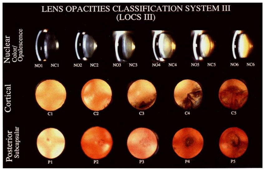 백내장 자가 진단, 백내장 초기 증상, 백내장 치료 안약, 백내장 수술 시기, 백내장 초기 관리