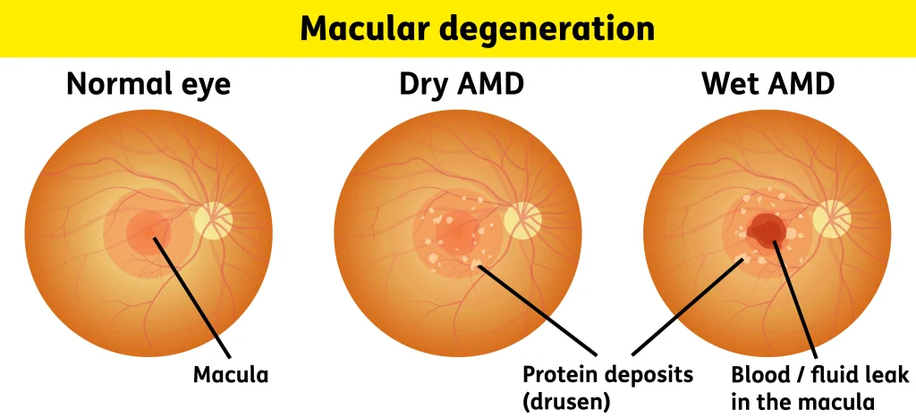 망막 주사, 눈에 이상한 잔상, 망막질환 종류, 망막 구조, 안구 내 주사