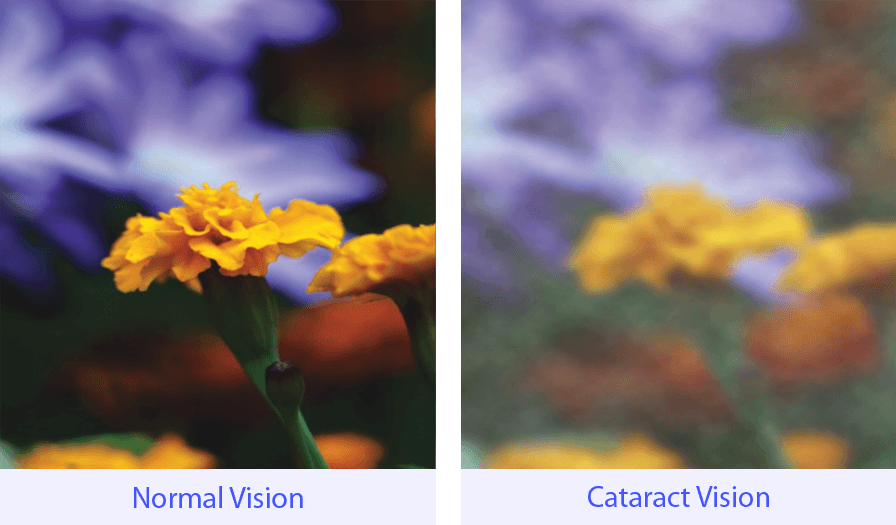 백내장 수술 후 시력, 백내장 초기 관리, 백내장 실비, 백내장 검사, 백내장 수술 방법