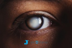 백내장 한쪽 눈만 수술, 백내장 증상 사진, 백내장 검사 비용, 백내장 수술 후 시력, 백내장 초기 치료