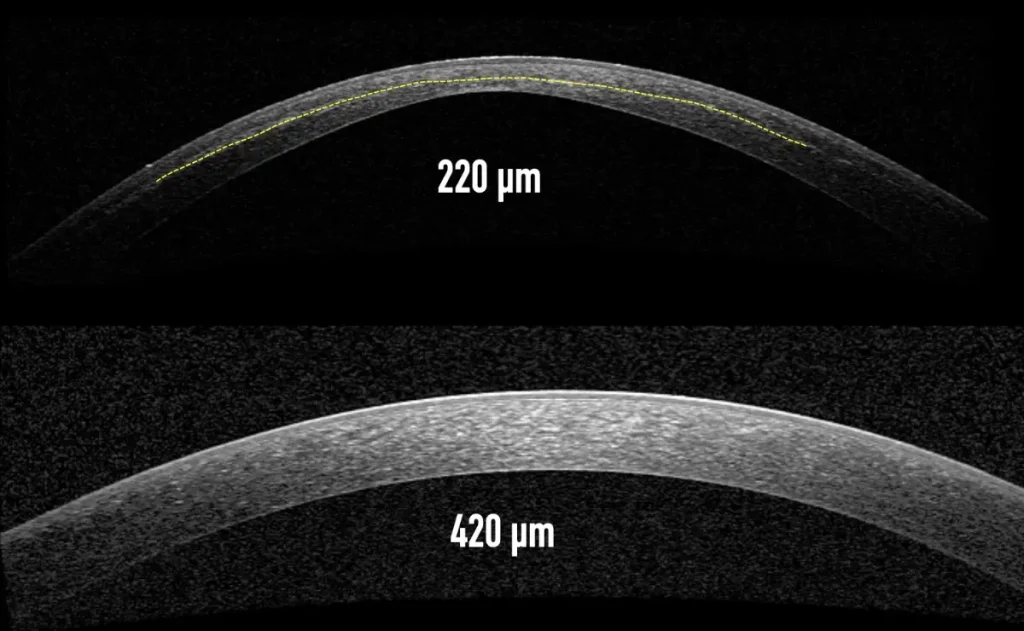 라식 각막 두께, 고도 난시 기준, 라식 안되는 눈, 고도 근시 라식, 라식 검사
