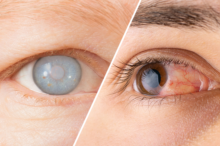 40대 백내장, 40대 노안, 40대 녹내장, 백내장 노안, 노안 오는 나이