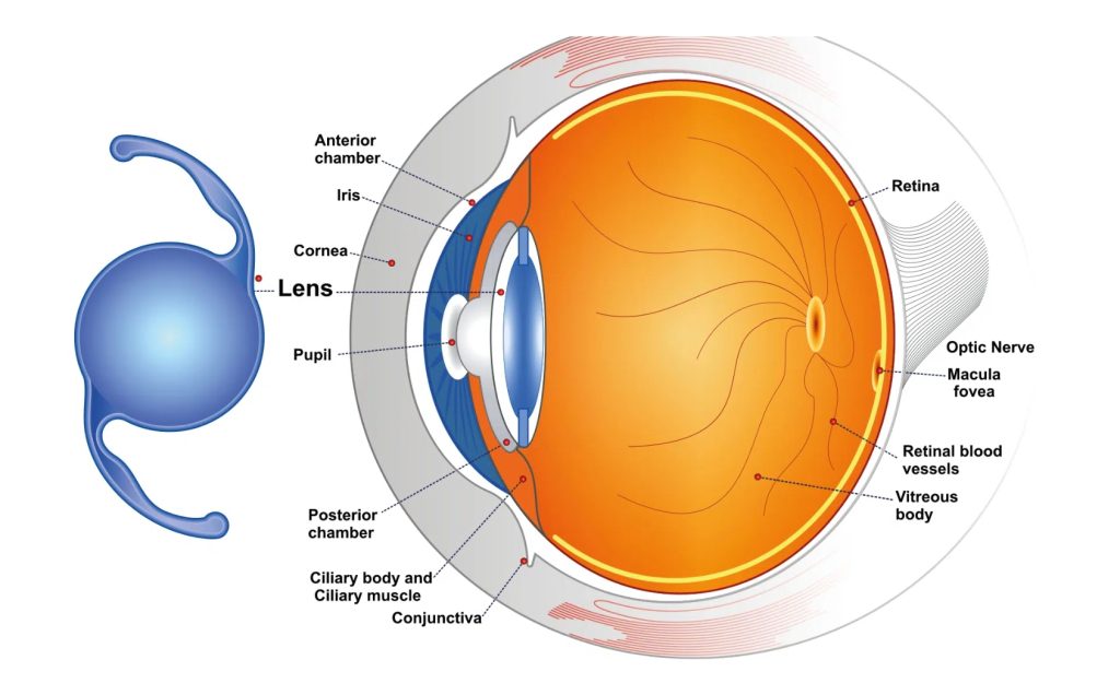 다초점렌즈 부작용, 다초점렌즈 종류, 백내장 다초점렌즈, 다초점렌즈 단점, 다초점 인공수정체