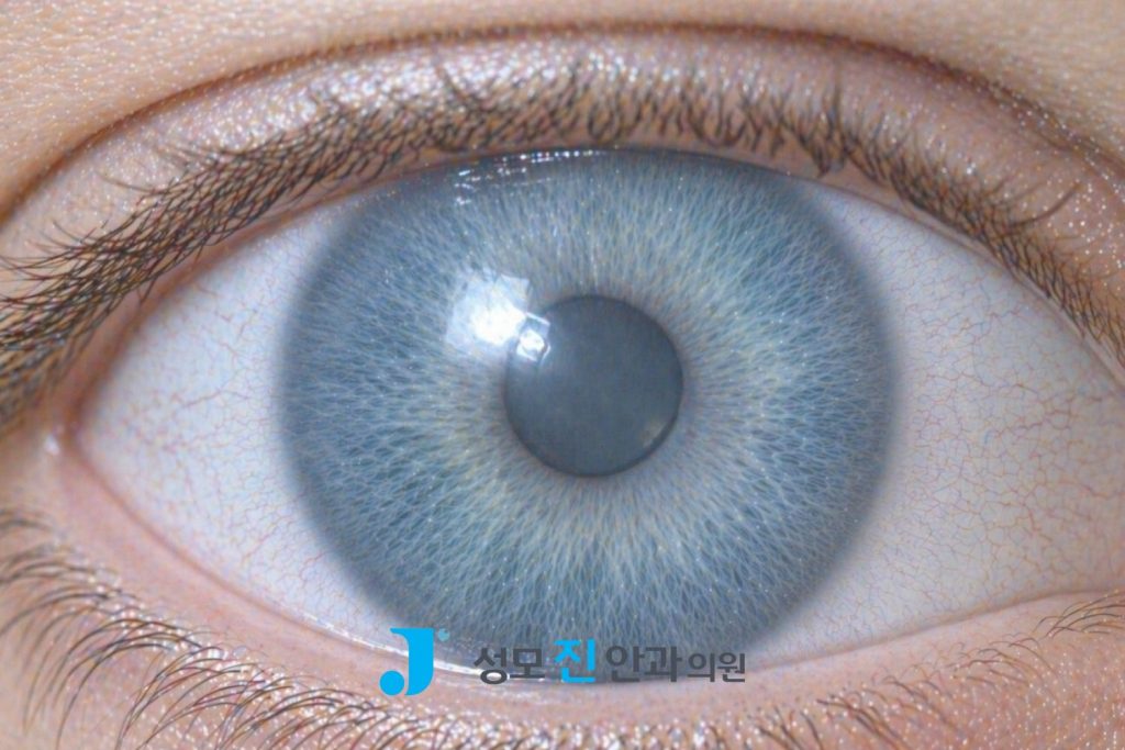 녹내장 눈동자, 녹내장 자가진단 각도, 녹내장에 안좋은 습관, 녹내장에 좋은 음식, 녹내장 영어로