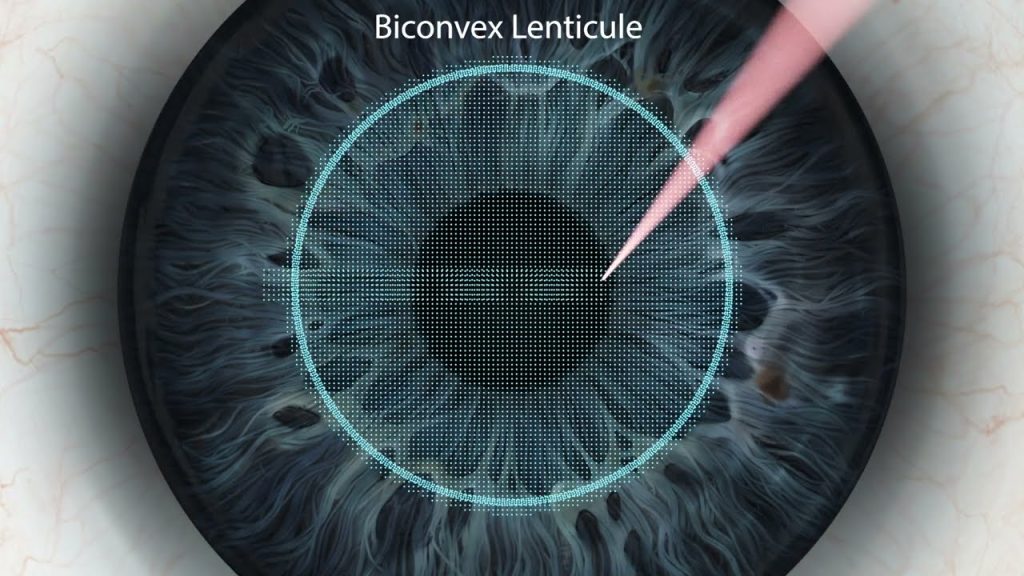 실크 라식, 스마일 라식 프로, 스마트라식 가격, 스마트라식하지마라, 라식 후 핸드폰 