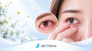 환절기 눈 가려움증과 알레르기성 결막염 증상 안내 - 성모진안과