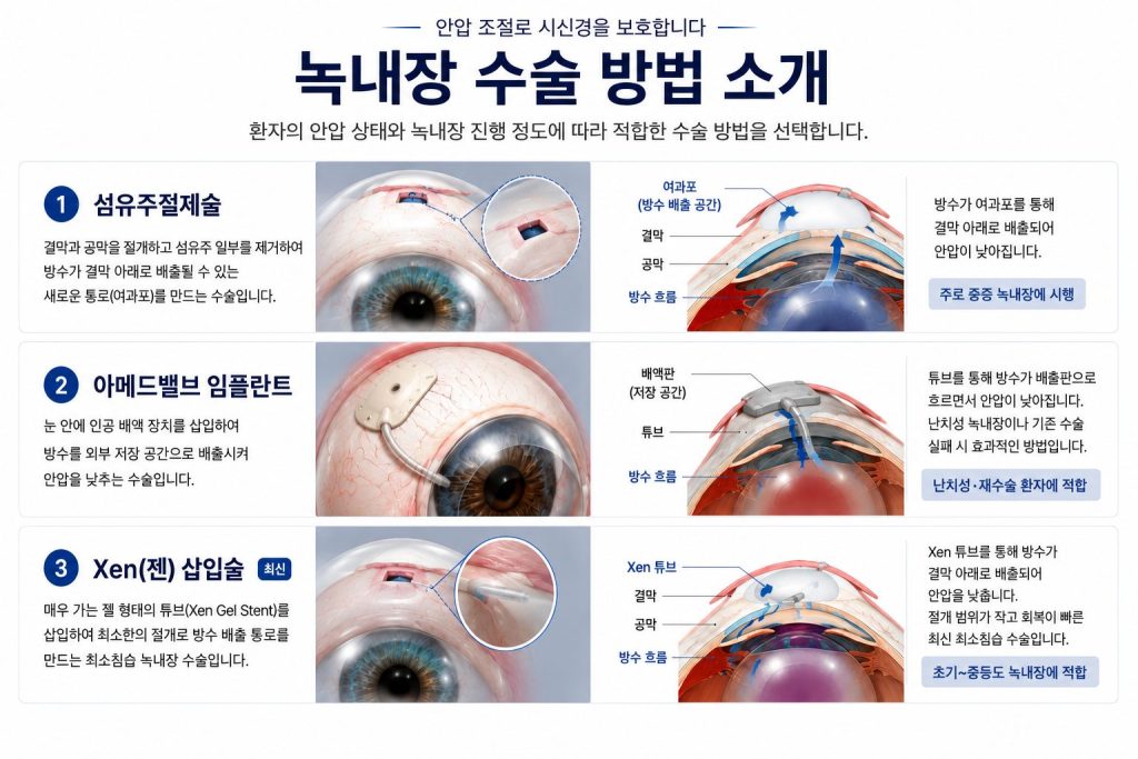 녹내장 수술 방법 3가지 소개