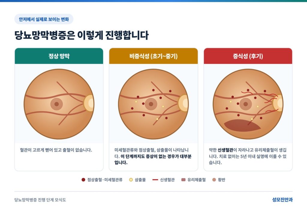 당뇨망막병증 진행