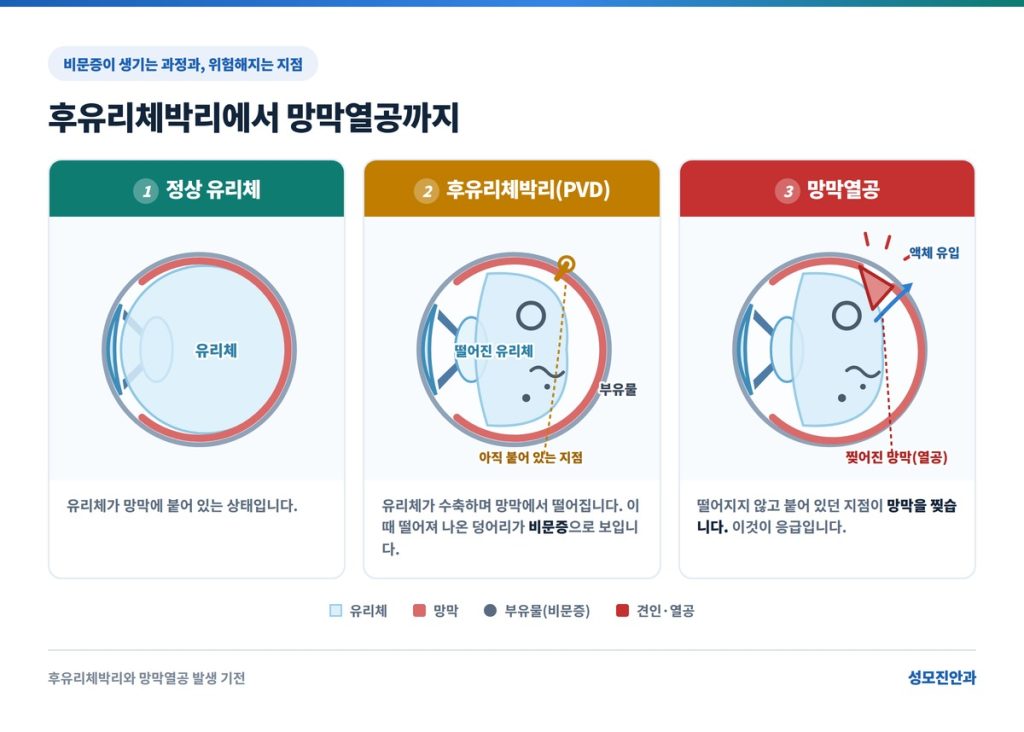 비문증의 발생기전 후유리체박리에서 망막열공까지