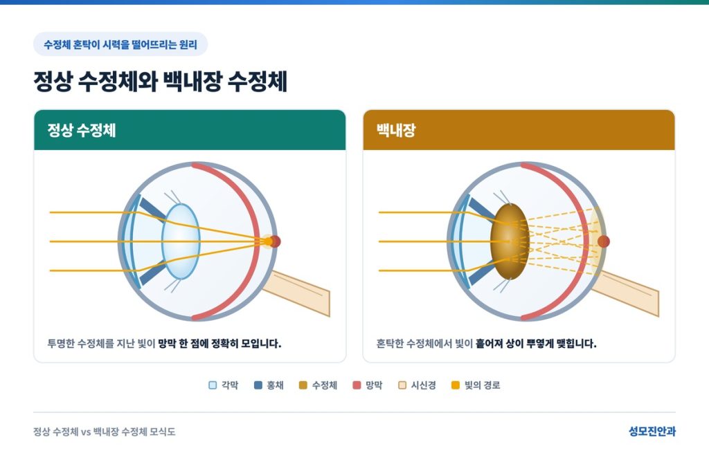 백내장 수정체 설명