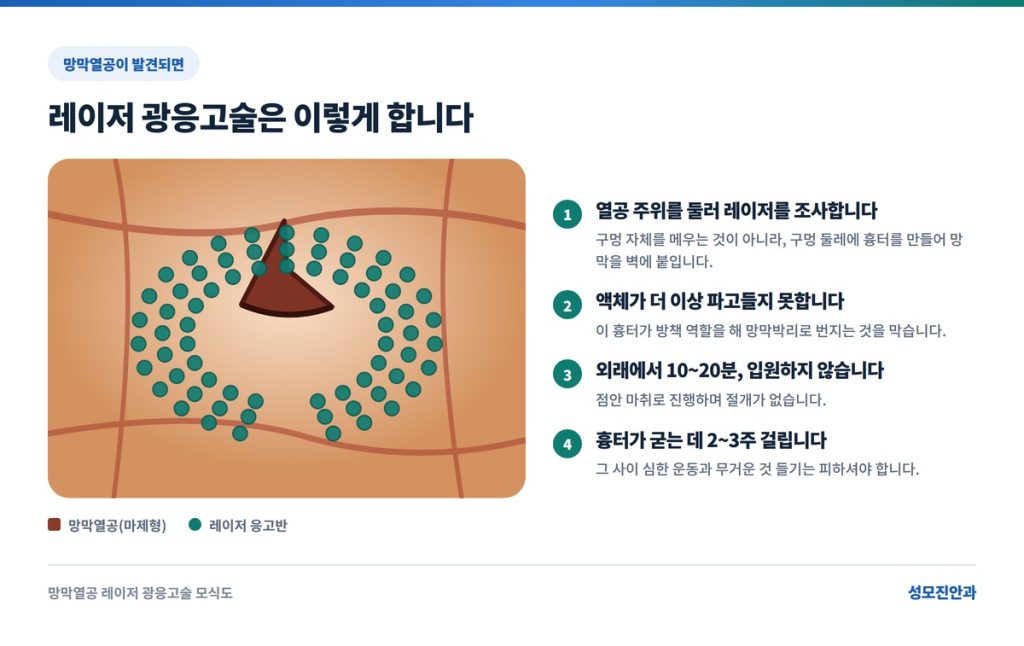 비문증의 치료 아르곤 레이저 광응고술