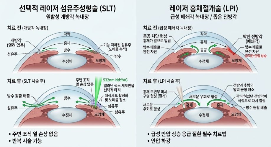 성모진안과 녹내장 레이저 치료 비교 모식도