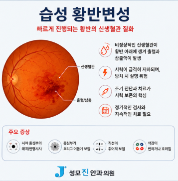 성모 진안과 습성 황반변성 망막주사