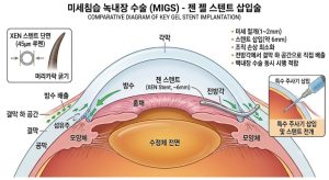 성모진안과 녹내장 젠 스텐트 수술 모식도