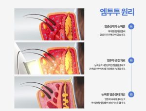 안구건조증 IPL치료