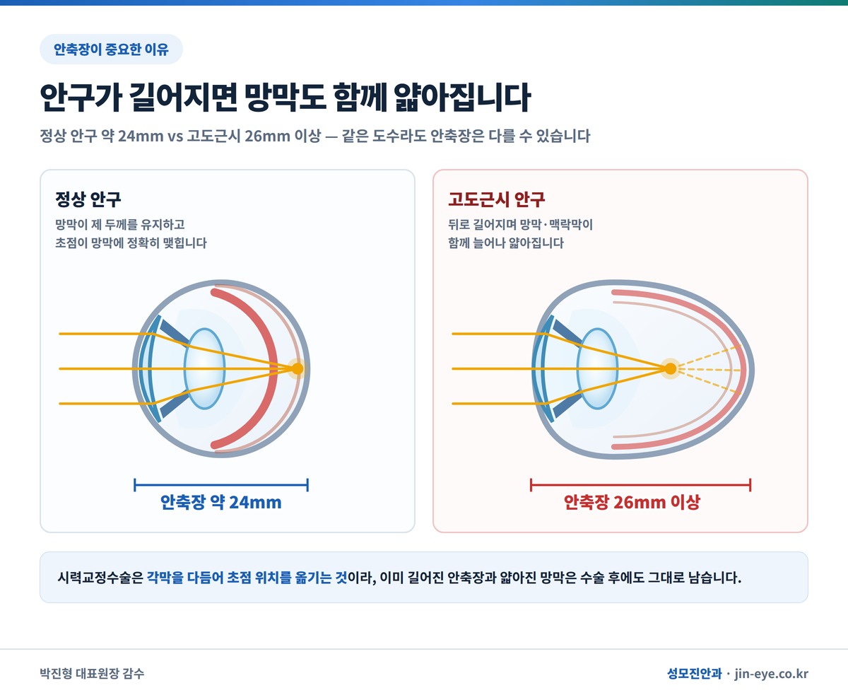 정상 안축장 24mm와 고도근시 안축장 26.5mm 이상 안구 단면 비교 및 얇아진 망막 모식도