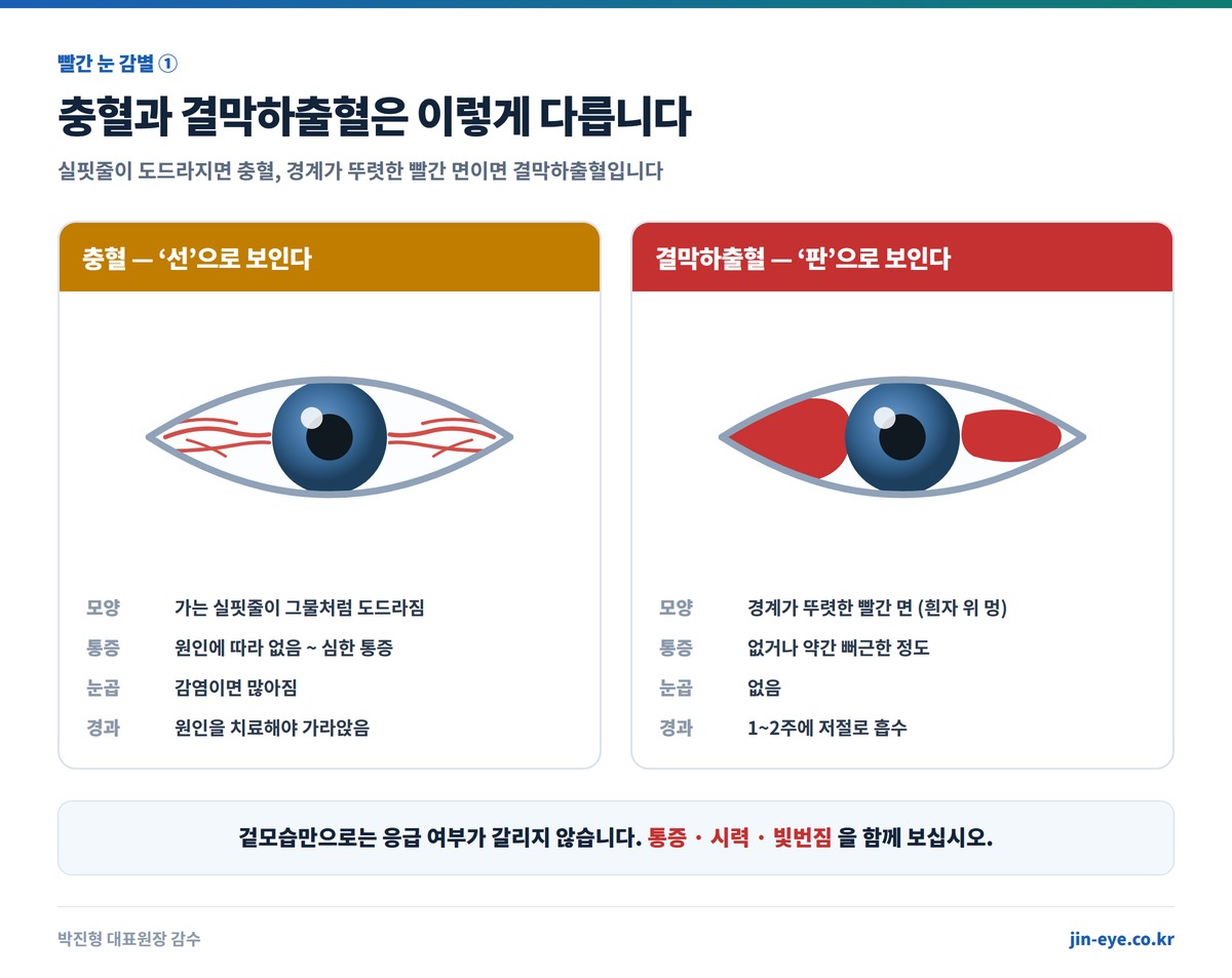 눈 충혈과 결막하출혈 차이 비교 - 충혈은 가는 실핏줄이 도드라지고 결막하출혈은 경계가 뚜렷한 빨간 면으로 보인다