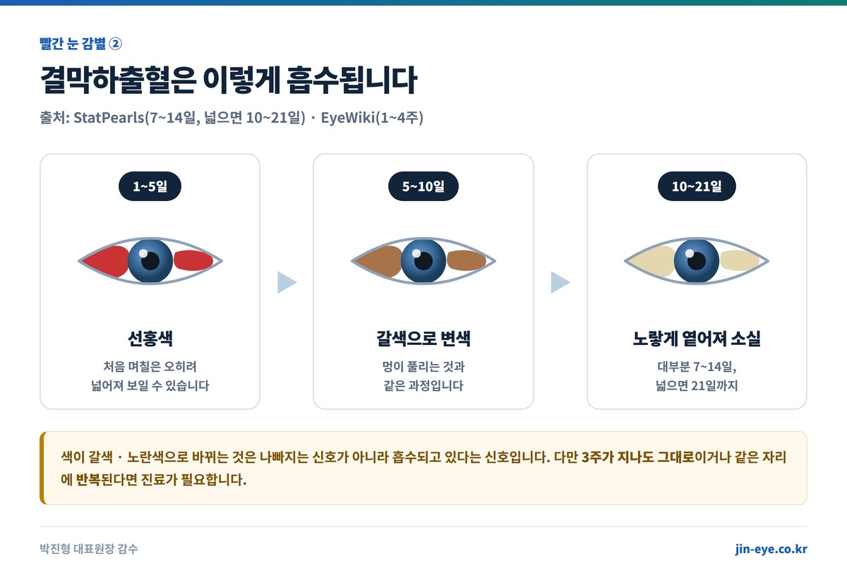 결막하출혈 흡수 경과 3단계 - 1~5일 선홍색, 5~10일 갈색·황색으로 변색, 10~21일 소실