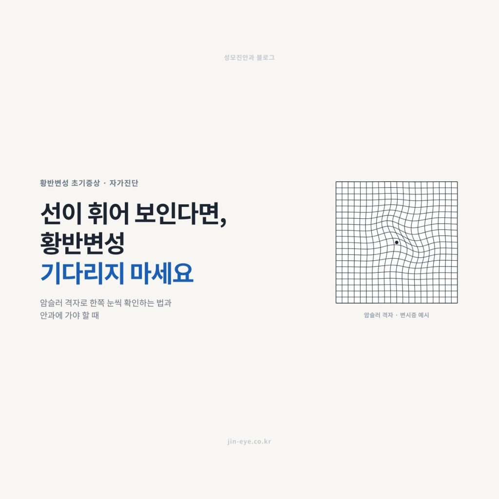 황반변성 초기증상 — 선이 휘어 보이는 암슬러 격자 변시증 예시