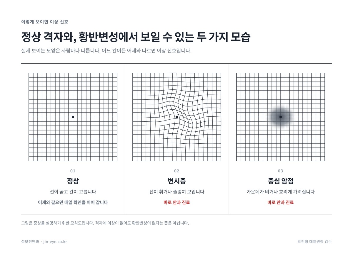 암슬러 격자 정상과 황반변성 이상 소견 비교 — 변시증(선이 휘어 보임)과 중심 암점(가운데가 가려짐)